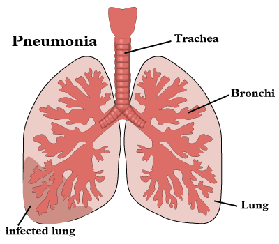 plaučių uždegimo simptomai svorio netekimas bob duncan svorio metimas